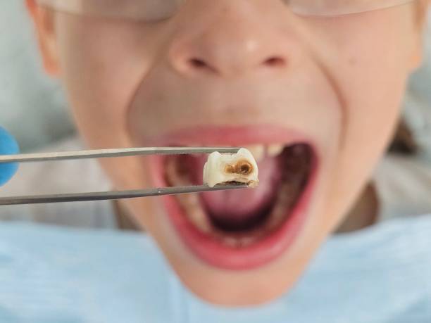 Best Same-Day Emergency Dental Services in Blue Jay, OH